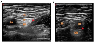 The Median Effective Analgesic Concentration of Ropivacaine in Sciatic Nerve Block Guided by Ultrasound After Arthroscopic Anterior Cruciate Ligament Reconstruction: A Double-Blind Up-Down Concentration-Finding Study